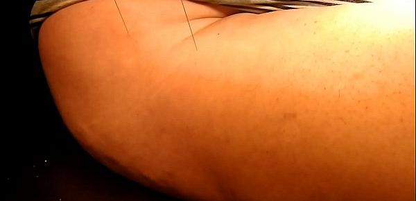  Acupuncture needles 2 with Playerdoi